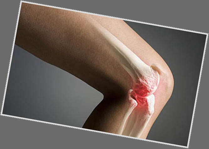 Эндопротезирование коленного сустава