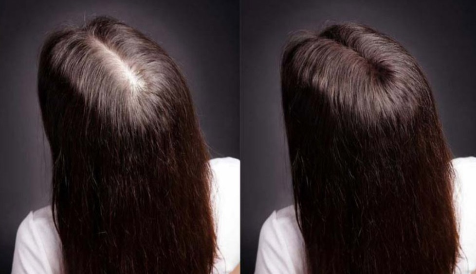 Мезотерапия волос до и после