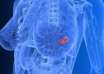 Киста в груди - что это и факторы диагностики