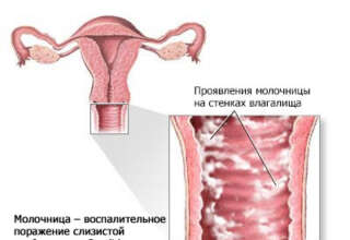 Лікування молочниці у жінок